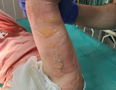 Miniatura: Dwulatka ciężko poparzona w przedszkolu....