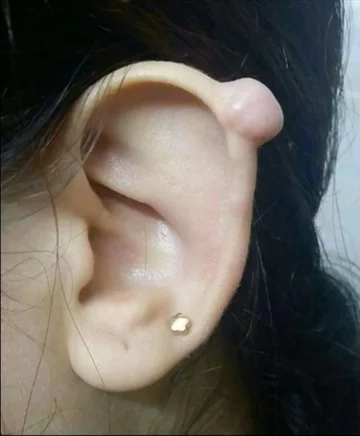 Metoda gumki recepturki 