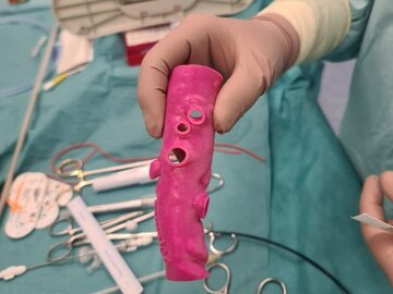 Przezsk&oacute;rna naprawa aorty piersiowo-brzusznej za&nbsp;pomocą modyfikowanego stent-graftu