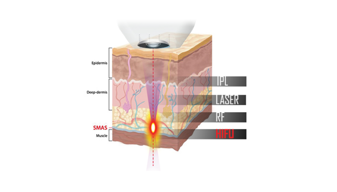 Zabieg HIFU polega na kontrolowanym urazie tkanek przez fale wysokiej częstotliwości. To uruchamia proces regeneracji i naprawy skóry, która odzyskuje jędrność i staje się bardziej napięta