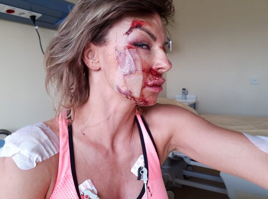 Miniatura: Drastyczne zdjęcia Beaty Wiater po wypadku