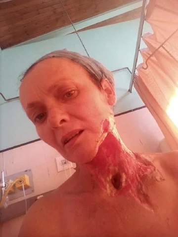 Madelein Carelse cierpi na martwicze zapalenie powięzi 