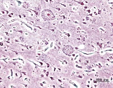 Miniatura: Nowy test na wykrycie Alzheimera....