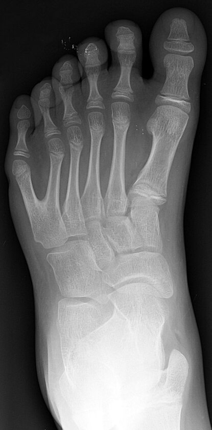 Rentgen lewej stopy osoby z polidaktylią 