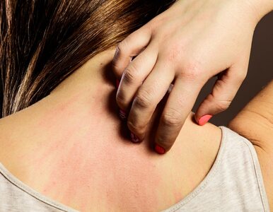Miniatura: Swędzenie skóry może świadczyć o anemii....