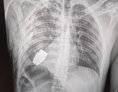 Miniatura: Błąd mógł pozbawić życia pacjenta i...