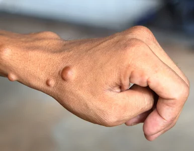 Miniatura: Neurofibromatoza typu 2 to rzadka choroba...