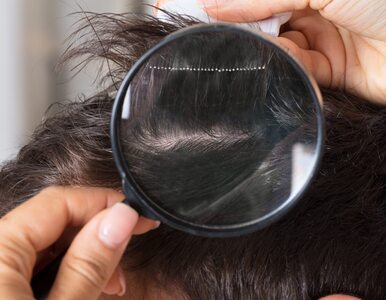 Przyczyny męskiego łysienia nie zawsze są oczywiste. Co do nich należy?