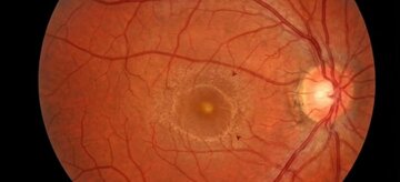 Retinopatia słoneczna