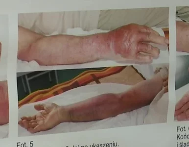 Miniatura: Sześciolatek ugryziony przez żmiję. „To...