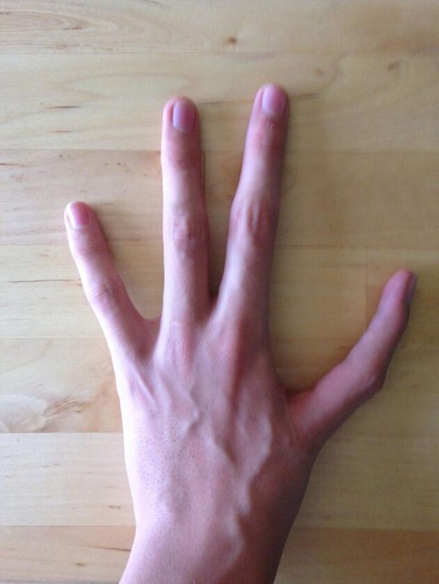 Symbrachydaktylia - wrodzona wada dłoni (zwykle polega na niezwykle małych rozmiarach palców, tu na braku) 