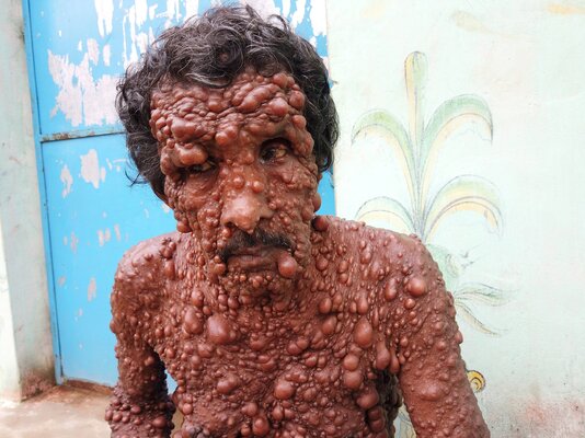 Miniatura: Cierpi na rzadkie schorzenie. Jego skórę...