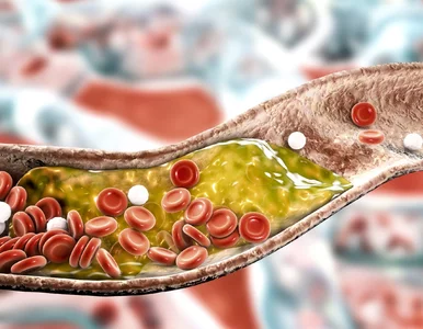 Miniatura: Wysoki poziom cholesterolu leczysz...