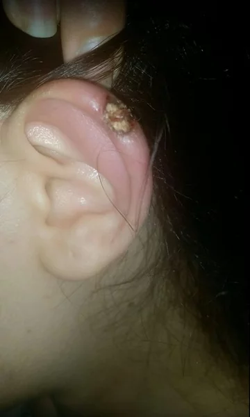 Metoda gumki recepturki 