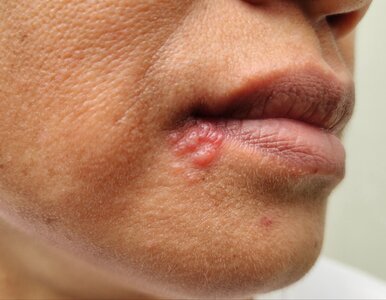 Miniatura: Opryszczka to nie tylko problem...