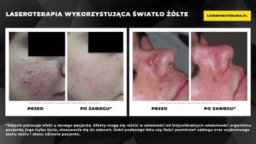 PRZED i&nbsp;PO zabiegu z&nbsp;wykorzystaniem światła ż&oacute;łtego