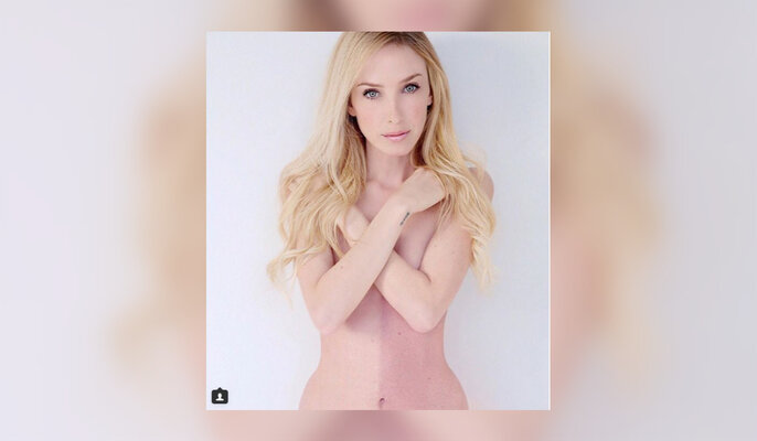 Miniatura: Cierpiąca na chimeryzm Taylor Muhl