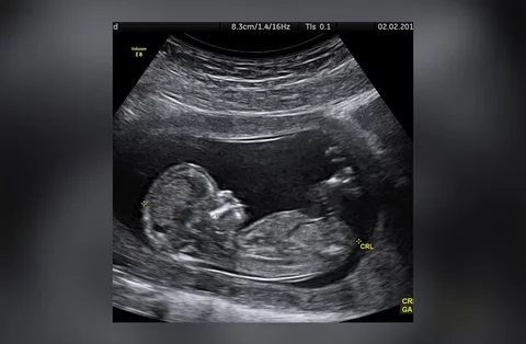 Zdjęcie USG pokazane przez Justina Biebera