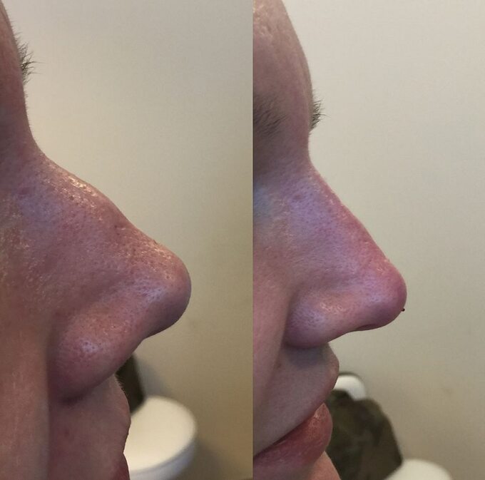 Skingen Clinic - niechirurgiczna korekta nosa z użyciem preparatu Radiesse
