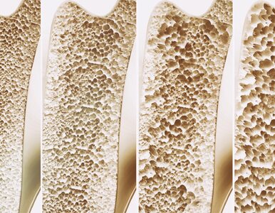 Miniatura: Osteoporoza – „cichy złodziej kości”....