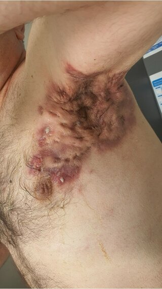 Zmiany charakterystyczne dla hidradenitis suppurativa