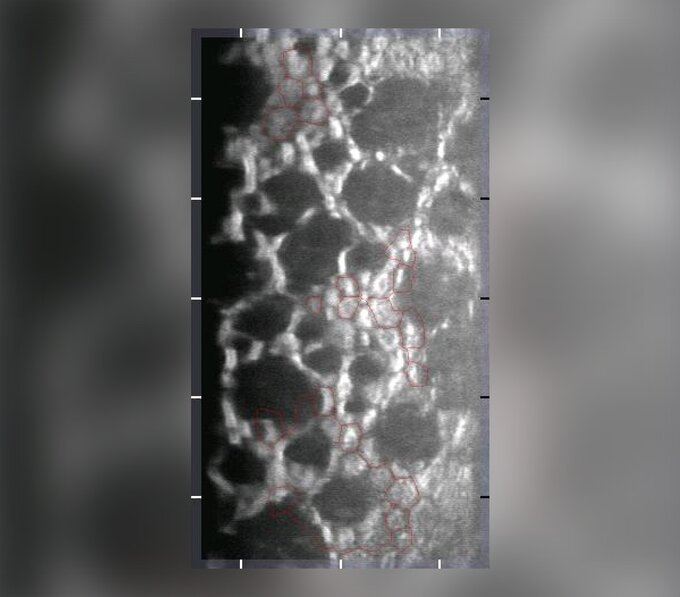 Śr&oacute;dbłonek rog&oacute;wki uszkodzony