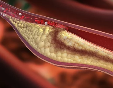 Miniatura: Zbyt wysoki cholesterol jest niebezpieczny...