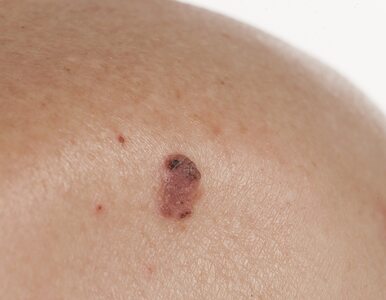 Miniatura: Rak płaskonabłonkowy skóry – rokowania,...