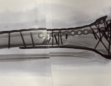 Miniatura: Lindsey Vonn przeszła koszmar. Odkryła...