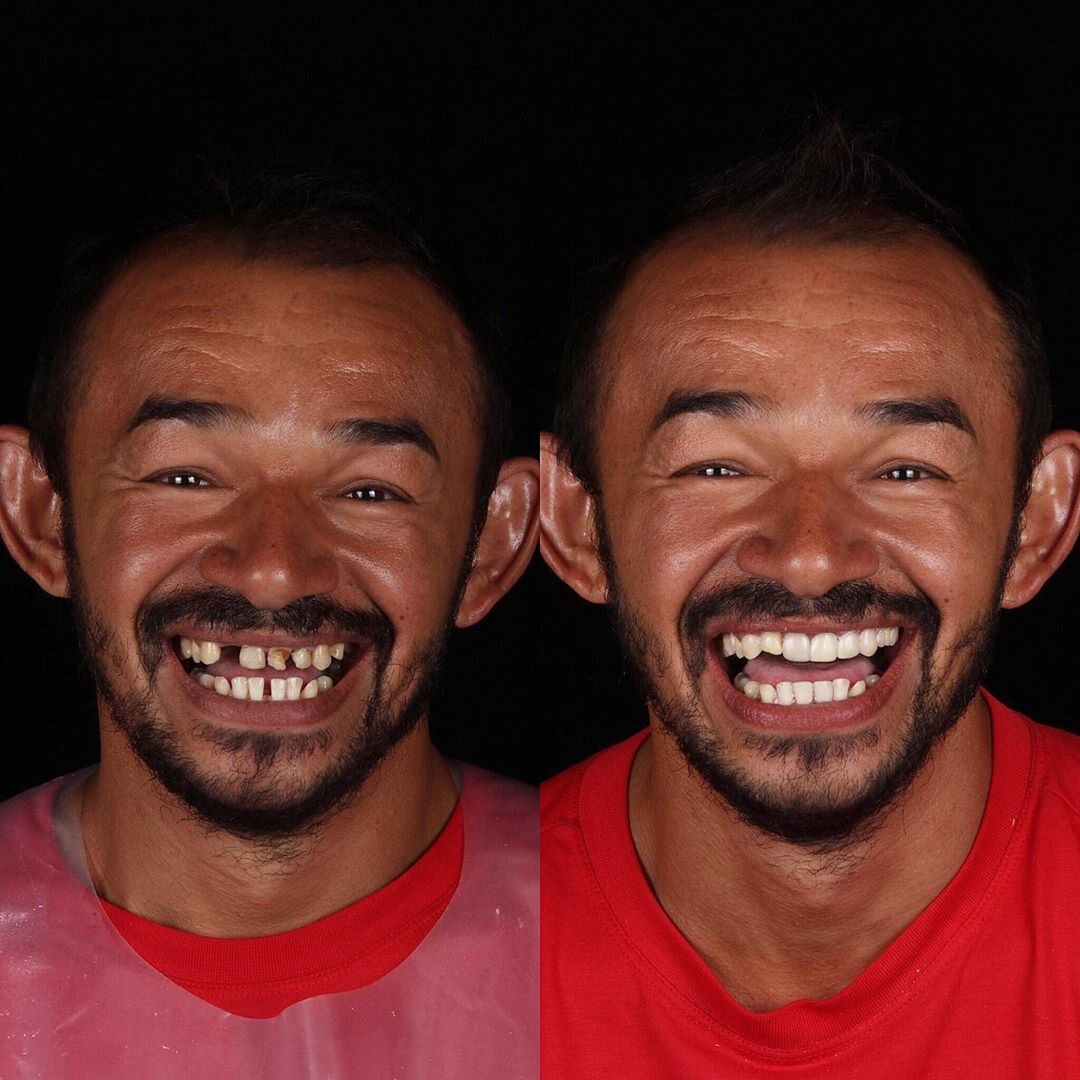 Zdjęcie wykonane przed i po leczeniu u Felipe Rossiego 