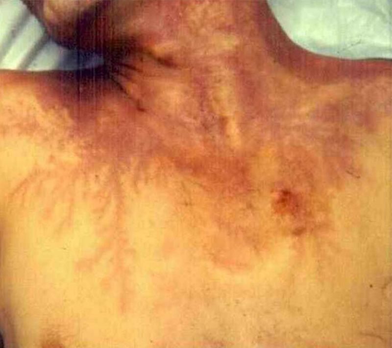 Zdjęcie ciała po uderzeniu pioruna 