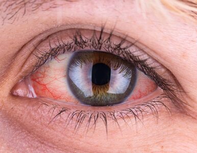 Miniatura: Przekrwione oczy mogą być oznaką choroby....