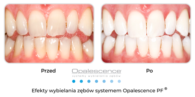 Wybielanie zębów Opalescence