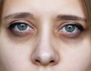Podkrążone oczy – objaw choroby czy defekt kosmetyczny?