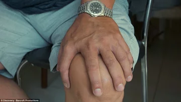 Członek rodziny Da Silva z polidaktylią 