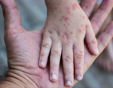 Miniatura: Jak odróżnić wysypkę alergiczną od...