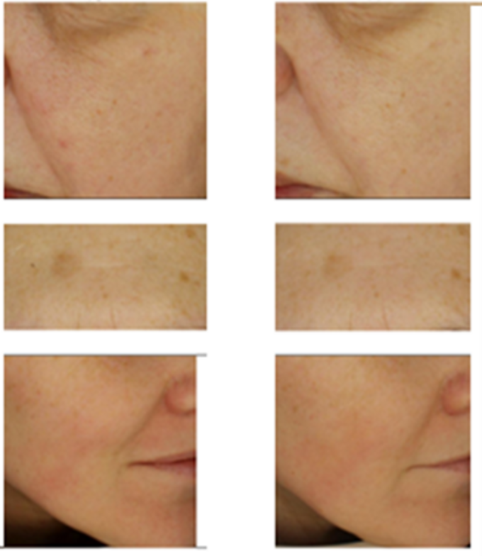 Zdjęcia fragmentów skóry twarzy w obrębie występowania przebarwień wykonane urządzeniem Visioface ®. Na fragmentach zdjęć wykonanych po regularnym stosowaniu serum (po 4 tygodniach) widać rozjaśnienie przebarwień i poprawę kolorytu skóry
