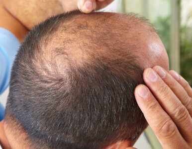 Miniatura: Przełom w leczeniu łysienia – naukowcy...