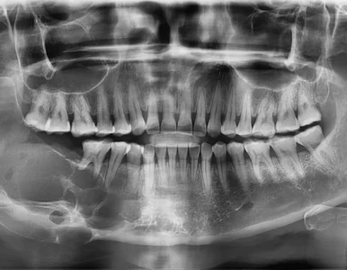 Miniatura: Jakie są objawy szkliwiaka? Diagnostyka i...