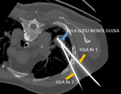 Miniatura: Dwie igły i mrożenie guza. Pierwszy taki...