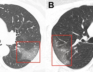 Miniatura: Tak koronawirus wpływa na płuca. Lekarze...