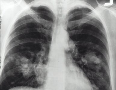 Miniatura: Zapalenie płuc nie jest „zwykłym...