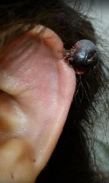 Metoda gumki recepturki 