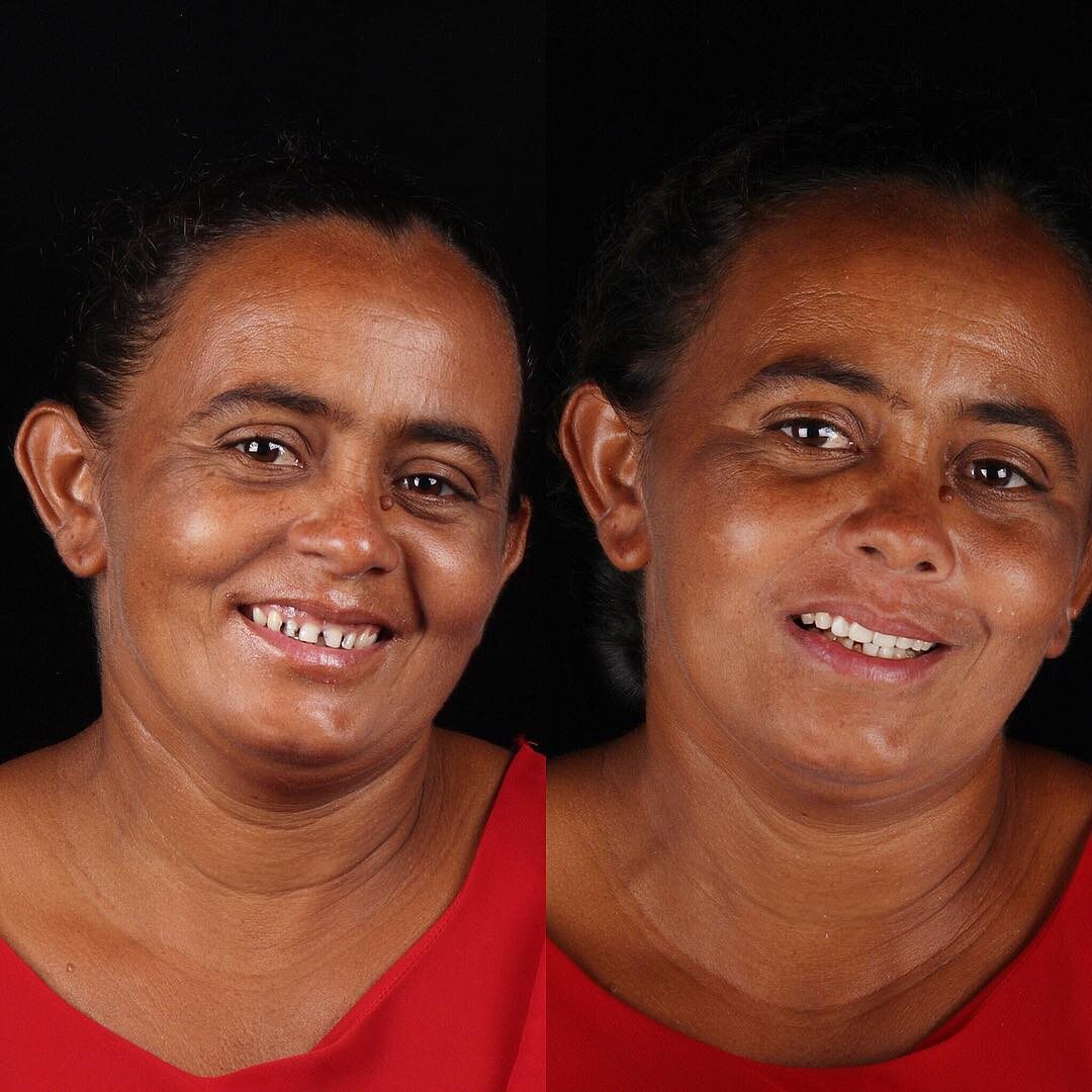 Zdjęcie wykonane przed i po leczeniu u Felipe Rossiego 