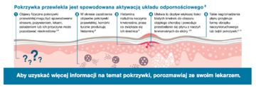 Pokrzywka przewlekła jest spowodowana aktywacją układu odpornościowego