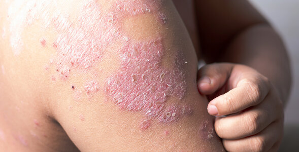 Miniatura: Łuszczyca