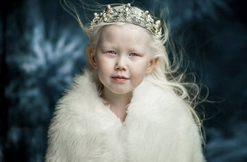 8-letnia albinoska Nariyana