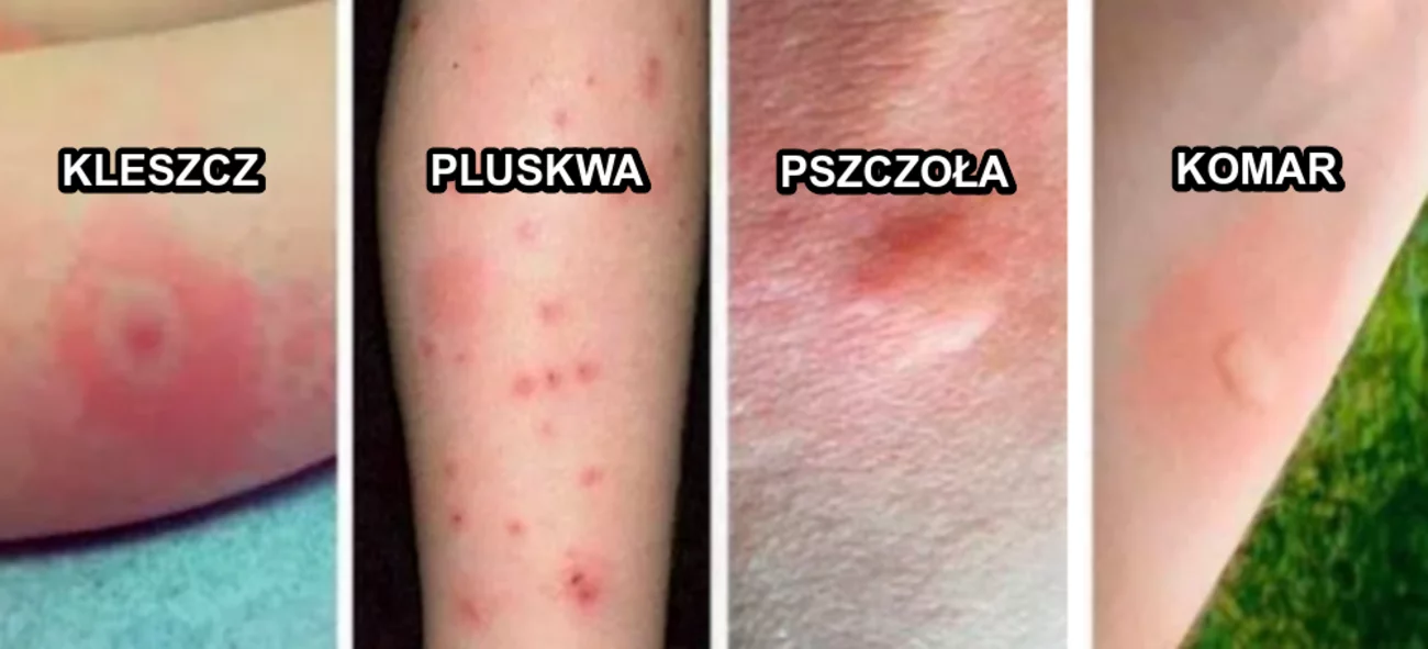 Jak poradzić sobie z wyjątkowo swędzącymi zmianami spowodowanymi ukąszeniami popularnych insektów?