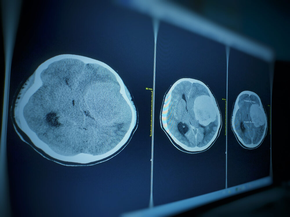 Hierbas para el meningioma: ¿son útiles en el tratamiento del cáncer?  Salud recta