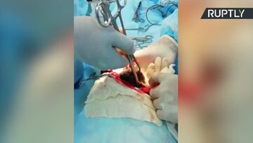 Chirurdzy usunęli z żołądka nastolatki... kulę włosów